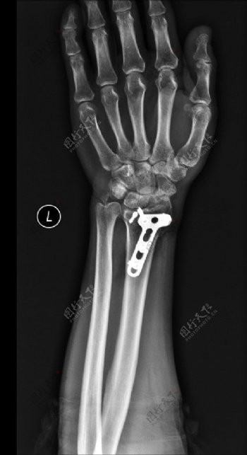 X线照片腕关节图片