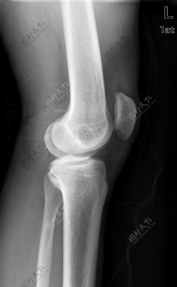 膝盖x光图片