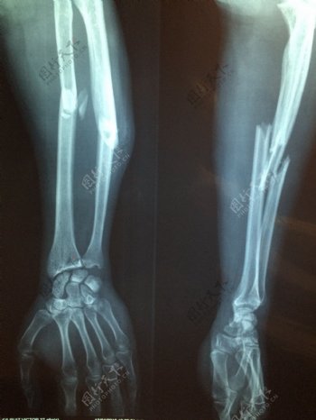 手骨骨折X光片