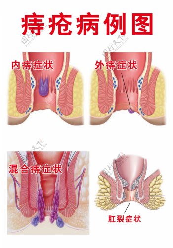 痔疮病例图