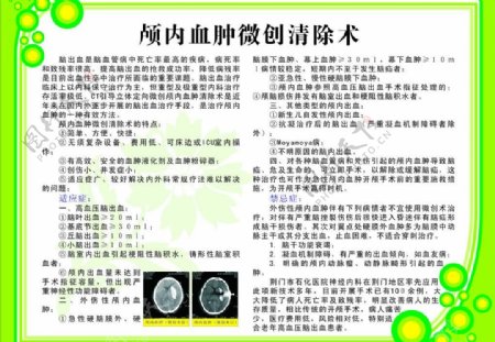 颅内血肿微创清除术图片