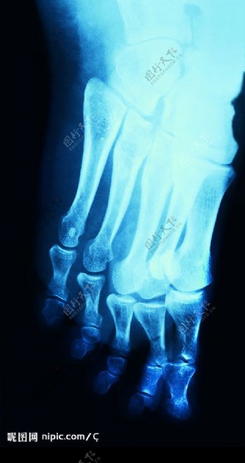 脚的X光图片