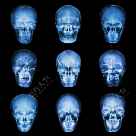 人脑X光片图片