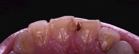 牙洞龋齿
