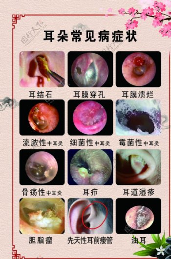 耳朵常见疾病图片